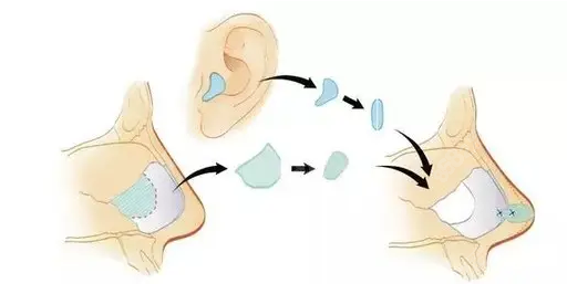 耳软骨隆鼻手术