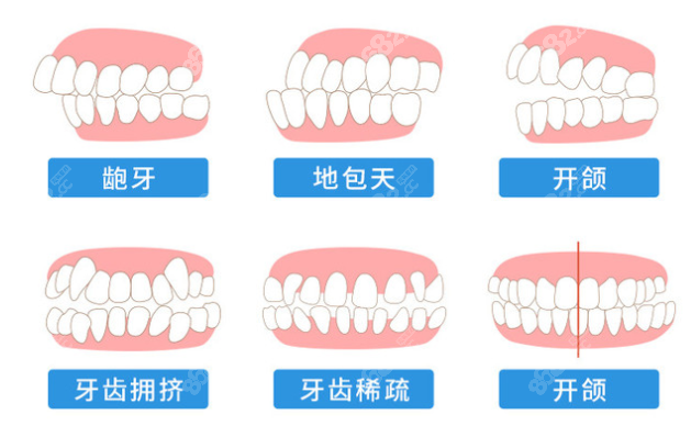 宁波恒美口腔牙套价格一览表