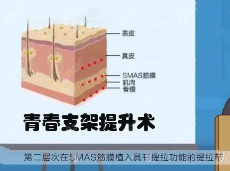 面部青春肽支架提升术