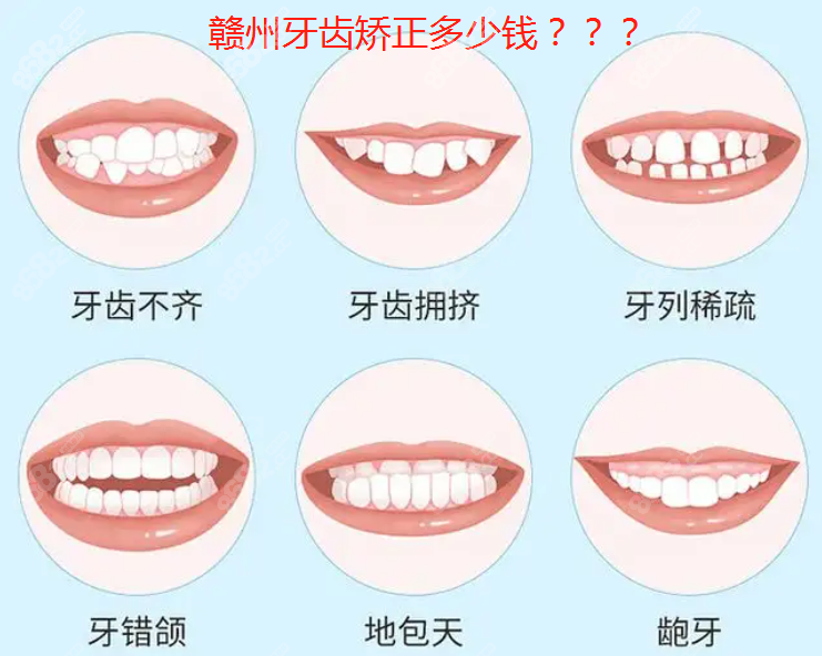 赣州牙齿矫正价格表