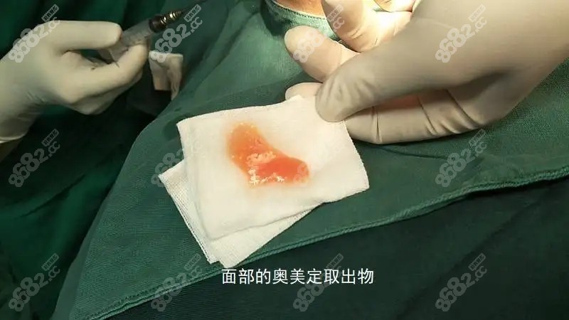 面部奥美定少量取出情况