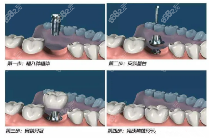 开州种植牙价格