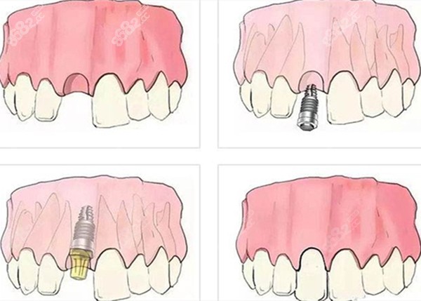种植牙的流程图