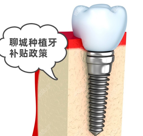 聊城种植牙补贴政策