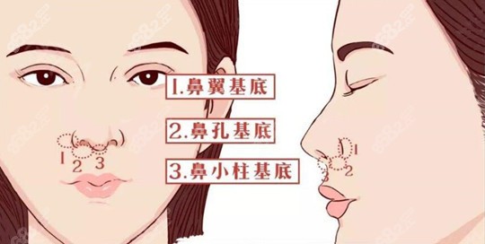 鼻基底凹陷是什么原因造成的
