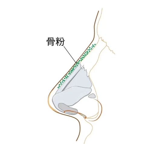 骨粉隆鼻取不干净有影响吗