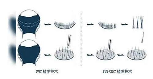 丛生植发微针技术