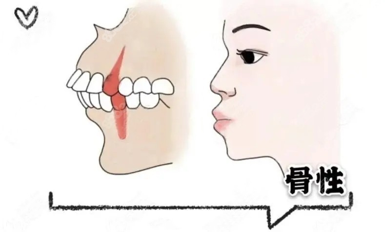 中重度的骨性龅牙需要做正颌手术