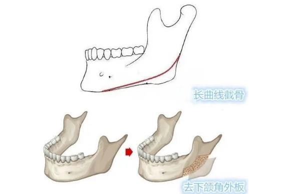 <!--<i data=20240705-sp></i>-->下颌角磨骨价格表