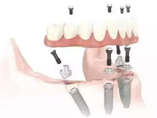 allon4全口种植牙技术