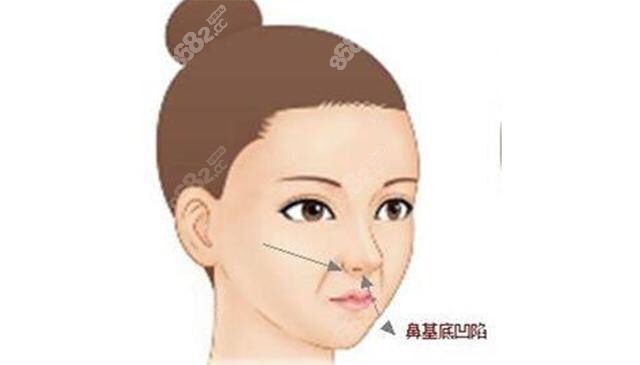 什么是鼻基底凹陷