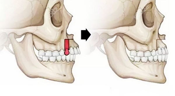 骨性龅牙手术多少钱图片