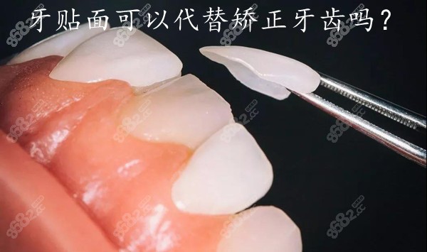 牙贴面可以代替矫正牙齿吗