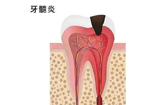 牙齿有了慢性牙髓炎