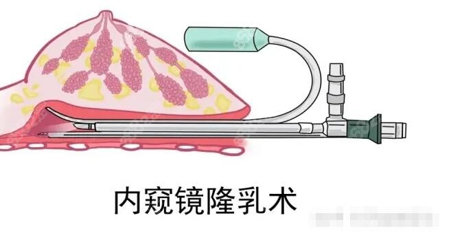 株洲华美整形隆胸技术好不好