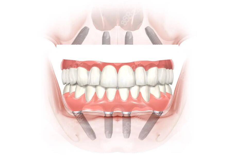 鄂州全口牙种植图片