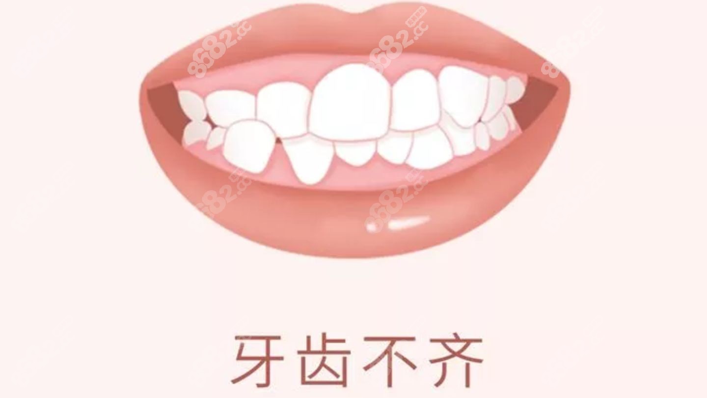 牙齿贴面怎么改善牙齿不整齐的问题