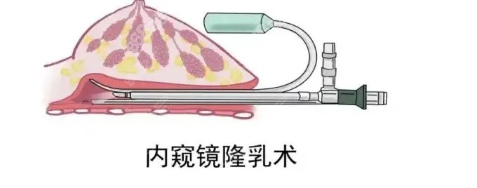 黄广香内窥镜隆胸技术优势