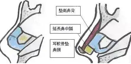 隆鼻需要注意的点