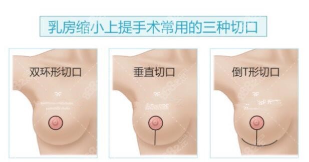 乳房缩小上提手术常用切口