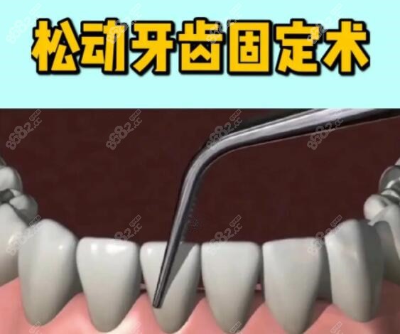 牙齿松动固定方法有几种