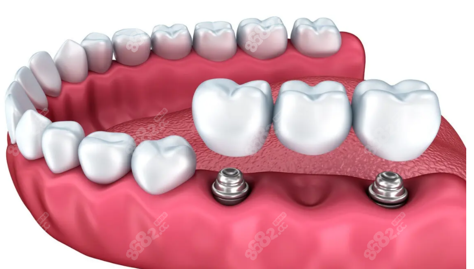 种植牙和全口义齿区别明显:种植牙更稳固,活动义齿性价比高