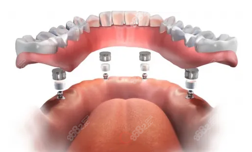 上颌半口半固定种植牙多少钱