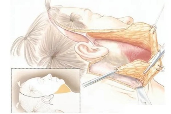 大拉皮手术的原理图