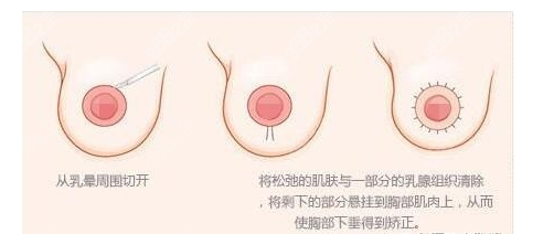 双环法乳房下垂手术过程