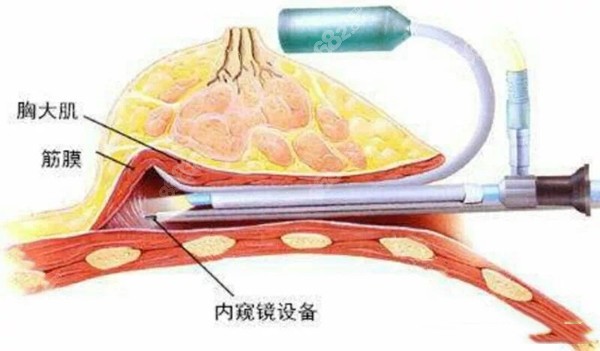 乌鲁木齐华美丰胸用的是内窥镜隆胸技术