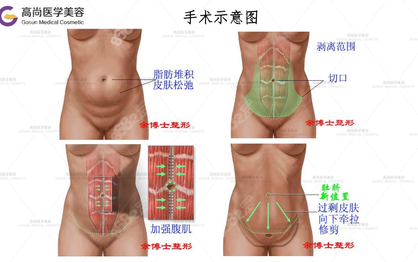 腹部拉皮手术示意图