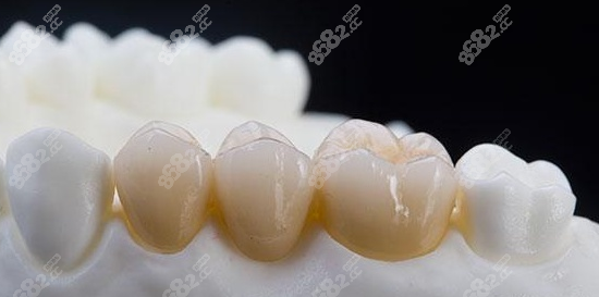 二氧化锆全瓷牙和普通全瓷牙的区别是什么