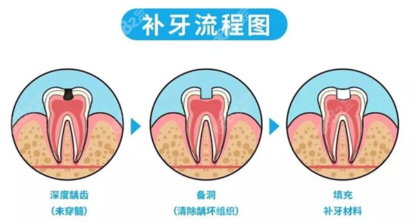 补牙流程图