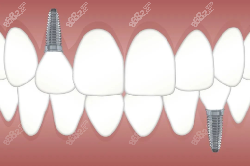 种植牙的位置决定数量