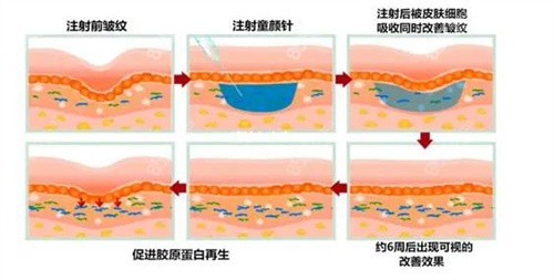 童颜针注射除皱原理