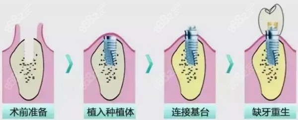 种植牙流程图