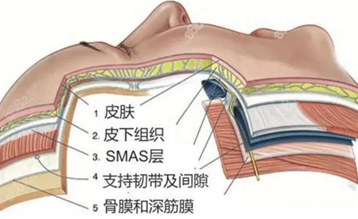 杨丽湘拉皮