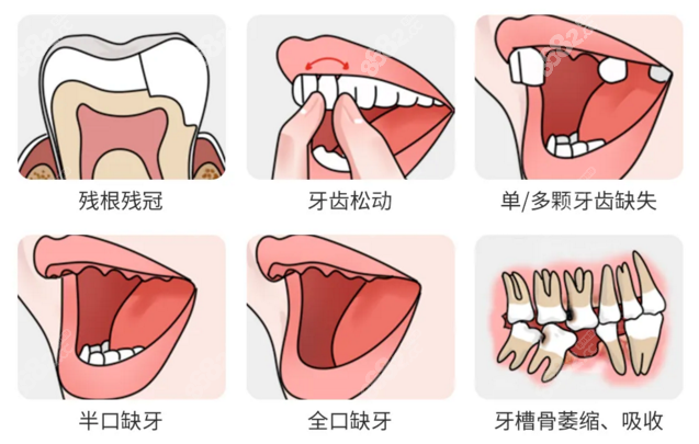 耒阳雅贝康口腔植牙价格表