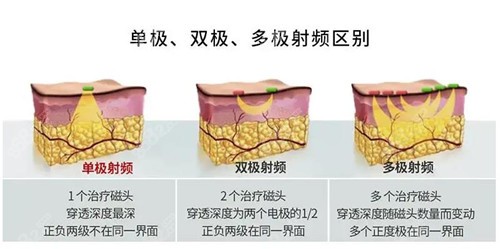 热玛吉属于单极射频