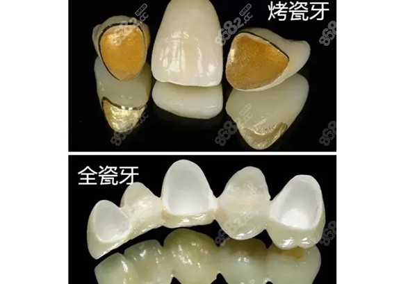 烤瓷牙和全瓷牙的内部图