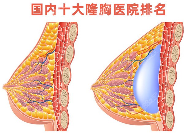 国内十大隆胸医院排名