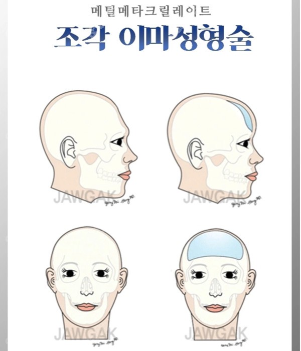 韩国雕刻整形医院骨水泥填充