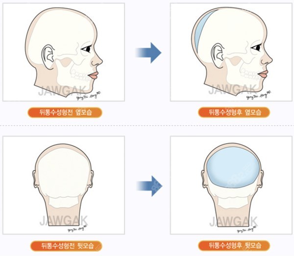 韩国雕刻整形医院骨水泥填充病例