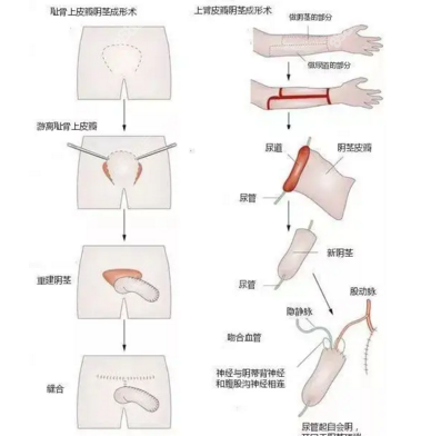 泰国mtf男变女变性手术价格