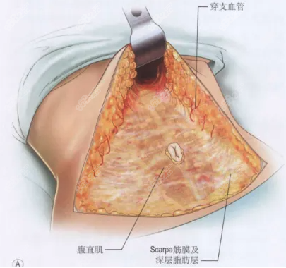 腹壁成形手术医院哪家好www.8682.cc