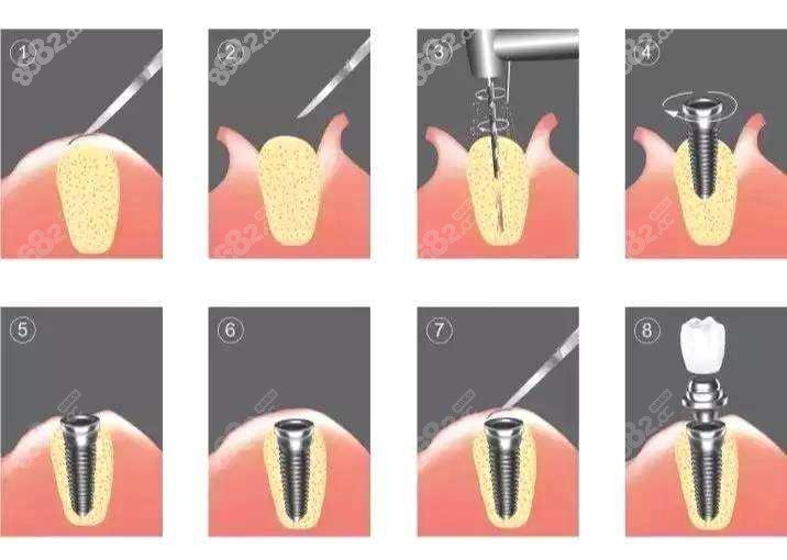 种植牙的步骤及流程