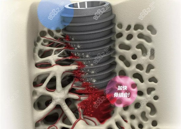 亲骨种植体表面处理技术介绍