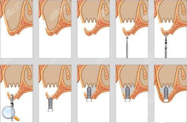 种植牙上颌窦提升术后并发症