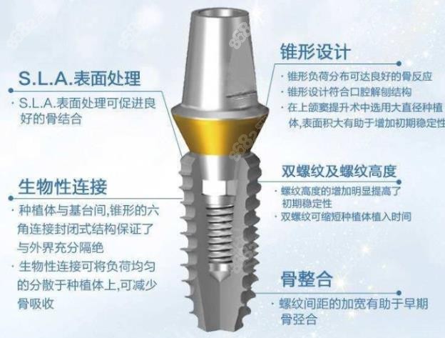 登腾植体优势