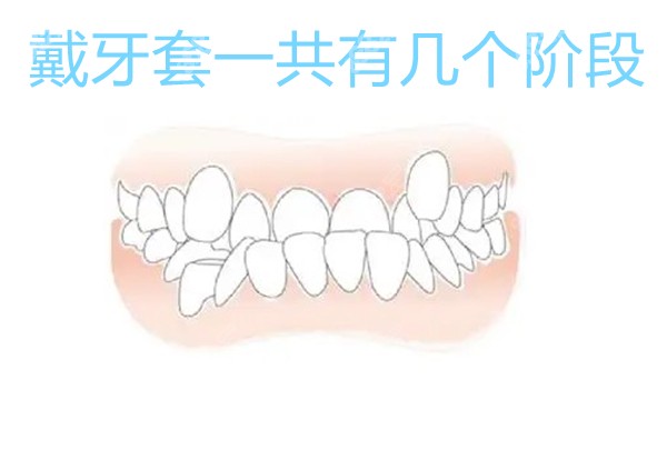 戴牙套一共有几个阶段